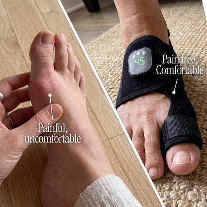 AlignX | EMS Bunion Corrector