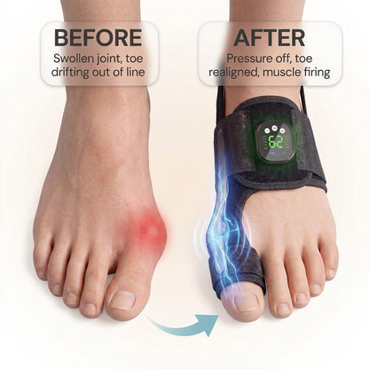 AlignX | EMS Bunion Corrector